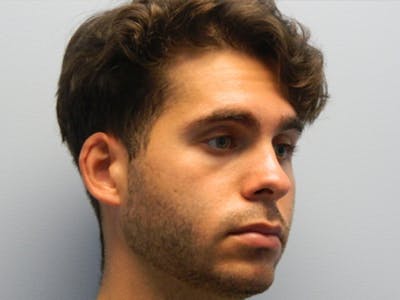 Rhinoplasty Before & After Gallery - Patient 133066641 - Image 1
