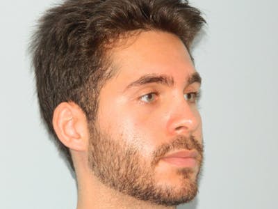 Rhinoplasty Before & After Gallery - Patient 133066641 - Image 2