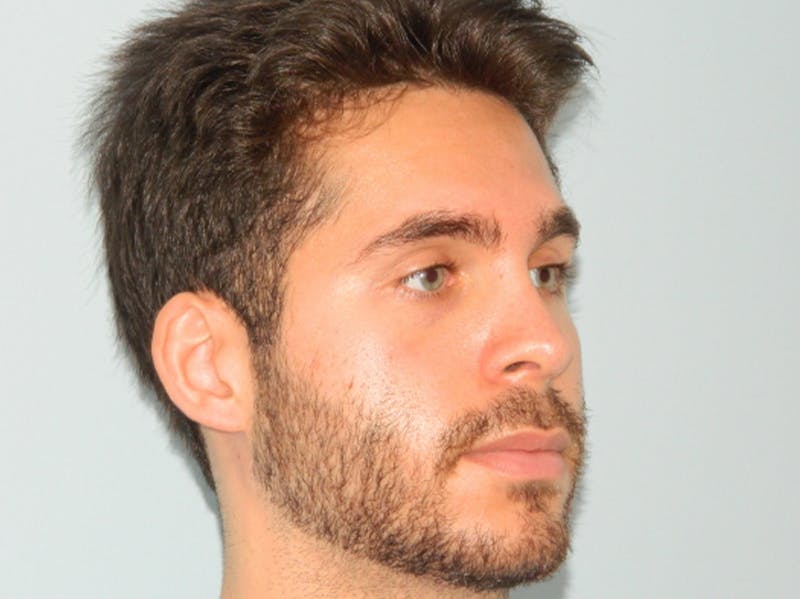 Rhinoplasty Before & After Gallery - Patient 133066641 - Image 2