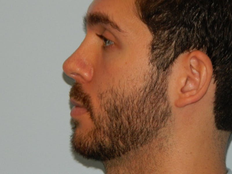Rhinoplasty Before & After Gallery - Patient 133066641 - Image 3