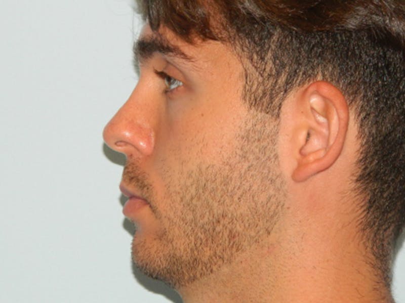 Rhinoplasty Before & After Gallery - Patient 133066641 - Image 4