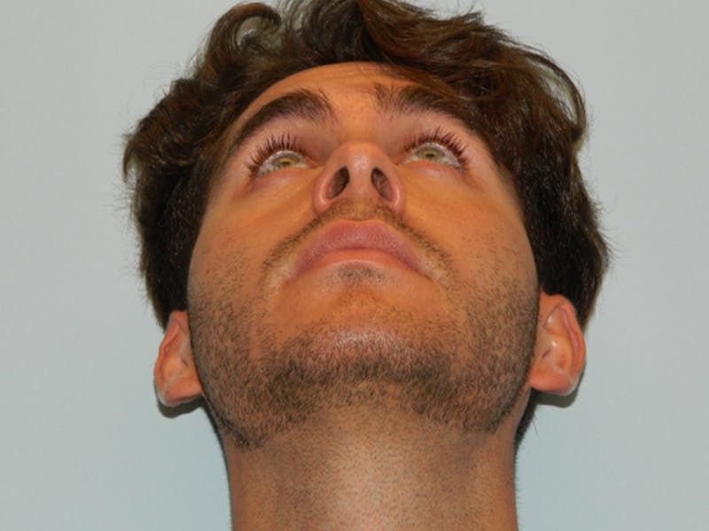 Rhinoplasty Before & After Gallery - Patient 133066641 - Image 5