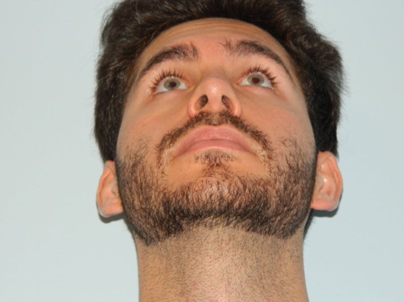 Rhinoplasty Before & After Gallery - Patient 133066641 - Image 6