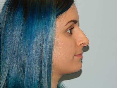 Rhinoplasty Before & After Gallery - Patient 133066643 - Image 1