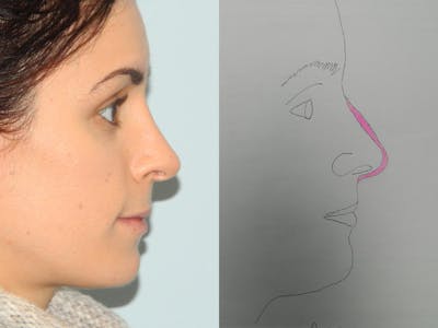 Rhinoplasty Before & After Gallery - Patient 133066643 - Image 2