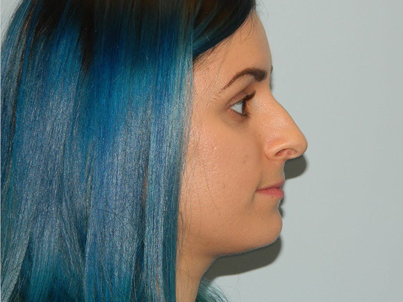 Rhinoplasty Before & After Gallery - Patient 133066643 - Image 3