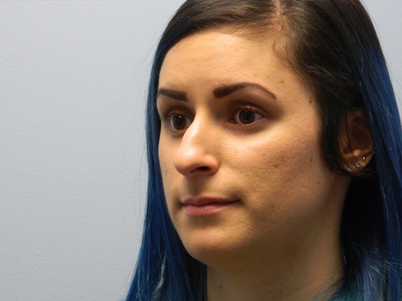 Rhinoplasty Before & After Gallery - Patient 133066643 - Image 5