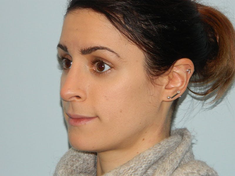 Rhinoplasty Before & After Gallery - Patient 133066643 - Image 6