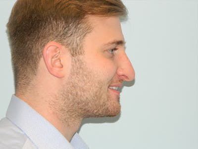 Rhinoplasty Before & After Gallery - Patient 133066647 - Image 1