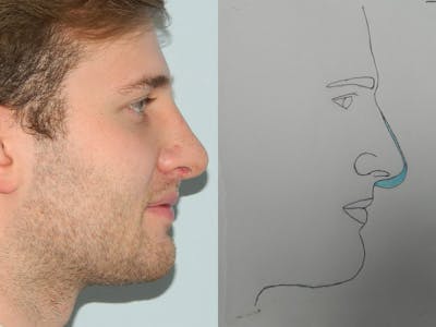 Rhinoplasty Before & After Gallery - Patient 133066647 - Image 2
