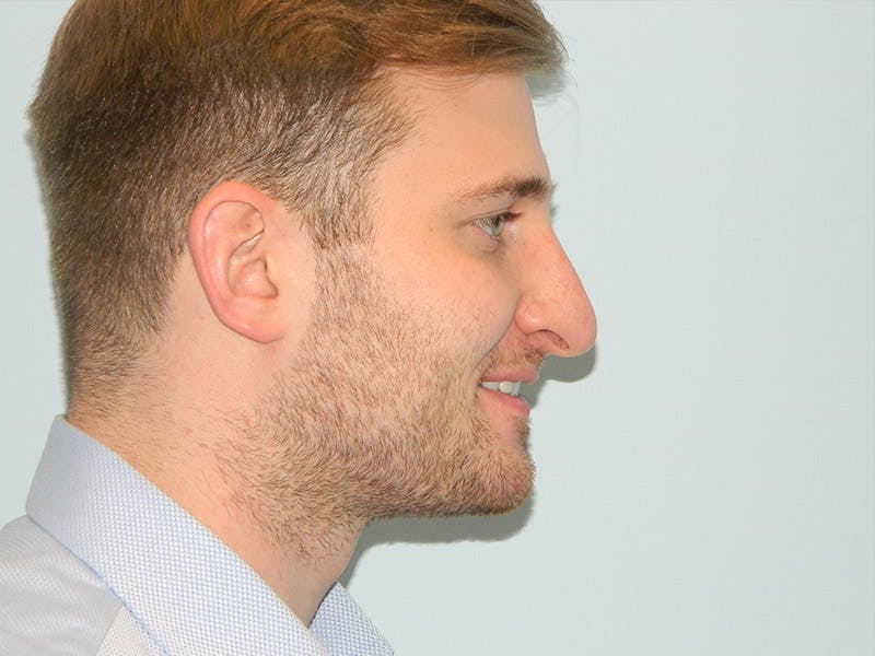 Rhinoplasty Before & After Gallery - Patient 133066647 - Image 3