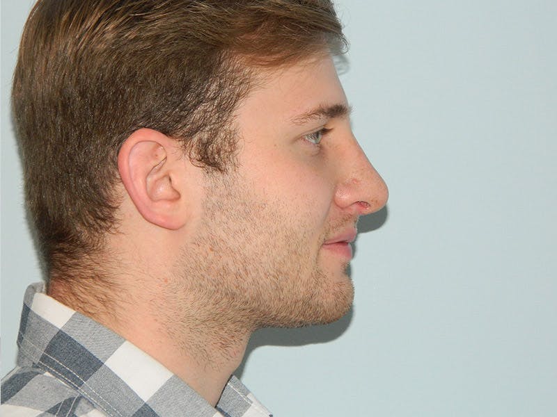 Rhinoplasty Before & After Gallery - Patient 133066647 - Image 4