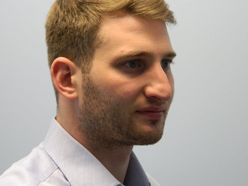 Rhinoplasty Before & After Gallery - Patient 133066647 - Image 5