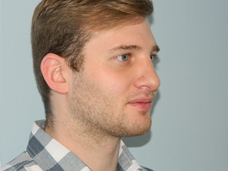 Rhinoplasty Before & After Gallery - Patient 133066647 - Image 6