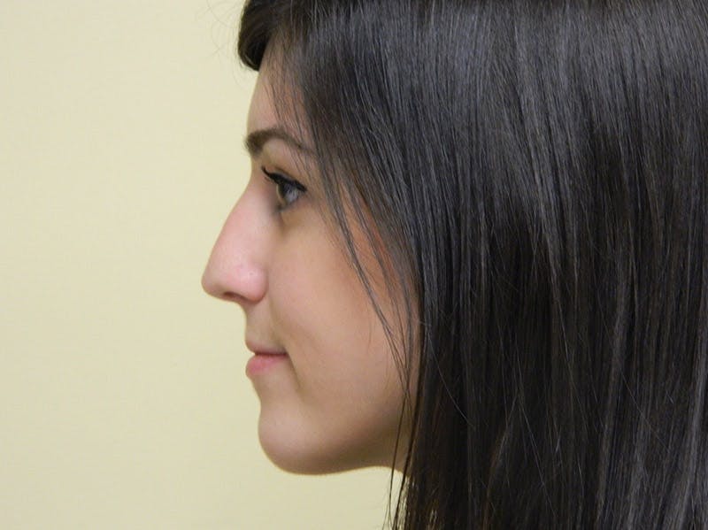 Rhinoplasty Before & After Gallery - Patient 133066651 - Image 1