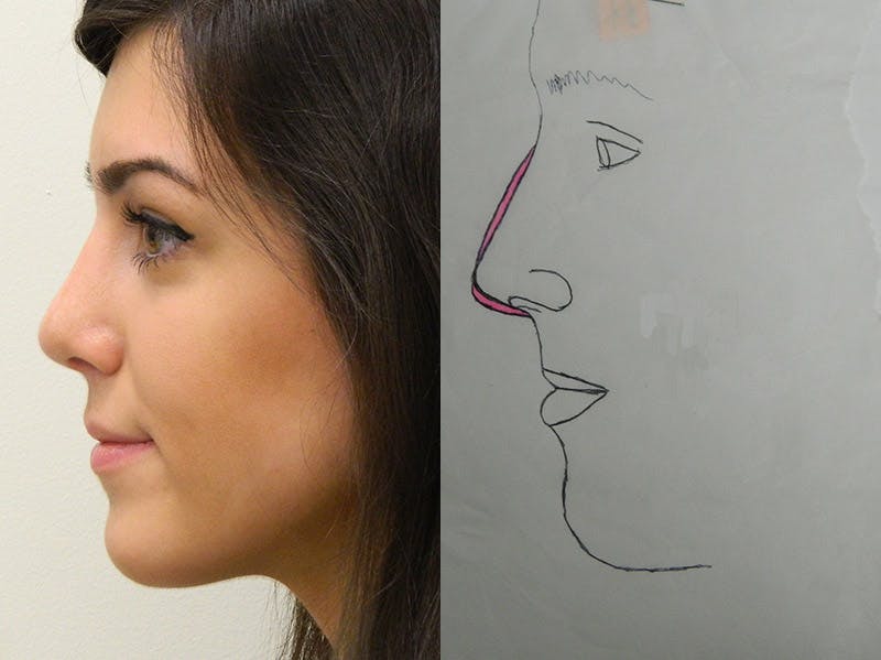 Rhinoplasty Before & After Gallery - Patient 133066651 - Image 2