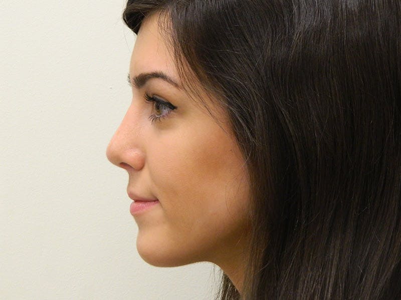 Rhinoplasty Before & After Gallery - Patient 133066651 - Image 4