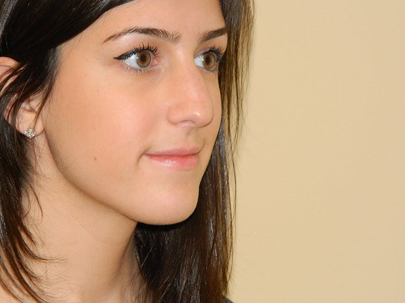 Rhinoplasty Before & After Gallery - Patient 133066651 - Image 5