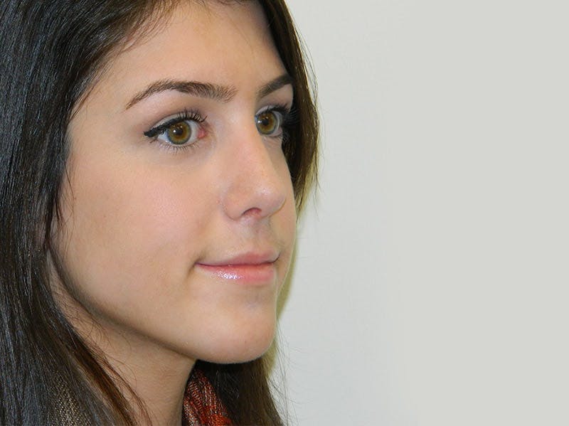 Rhinoplasty Before & After Gallery - Patient 133066651 - Image 6
