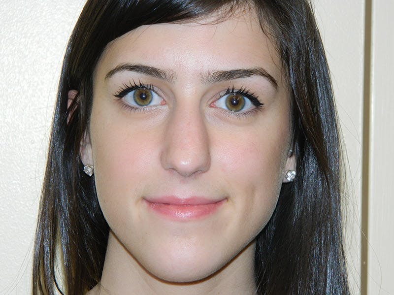 Rhinoplasty Before & After Gallery - Patient 133066651 - Image 7