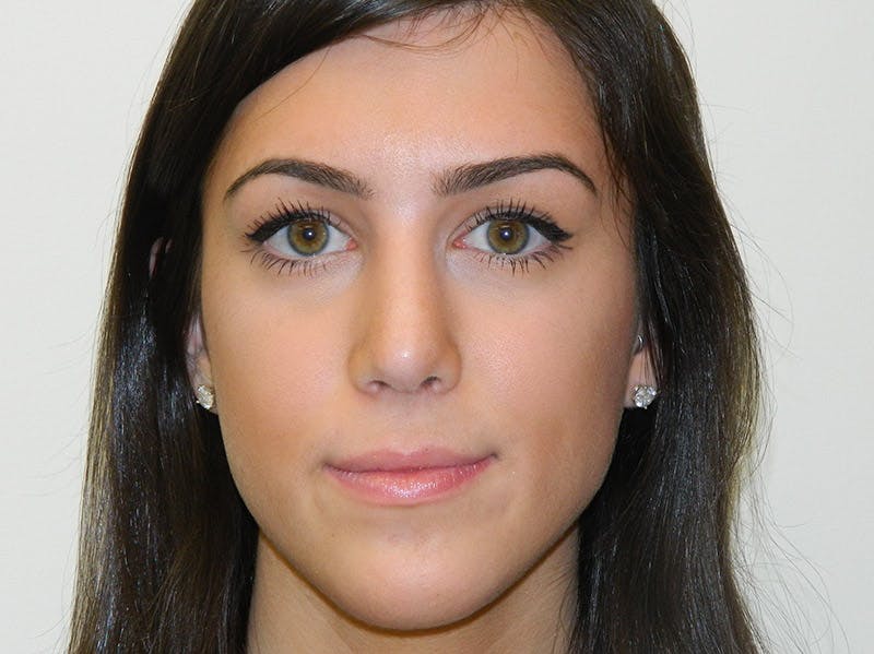 Rhinoplasty Before & After Gallery - Patient 133066651 - Image 8