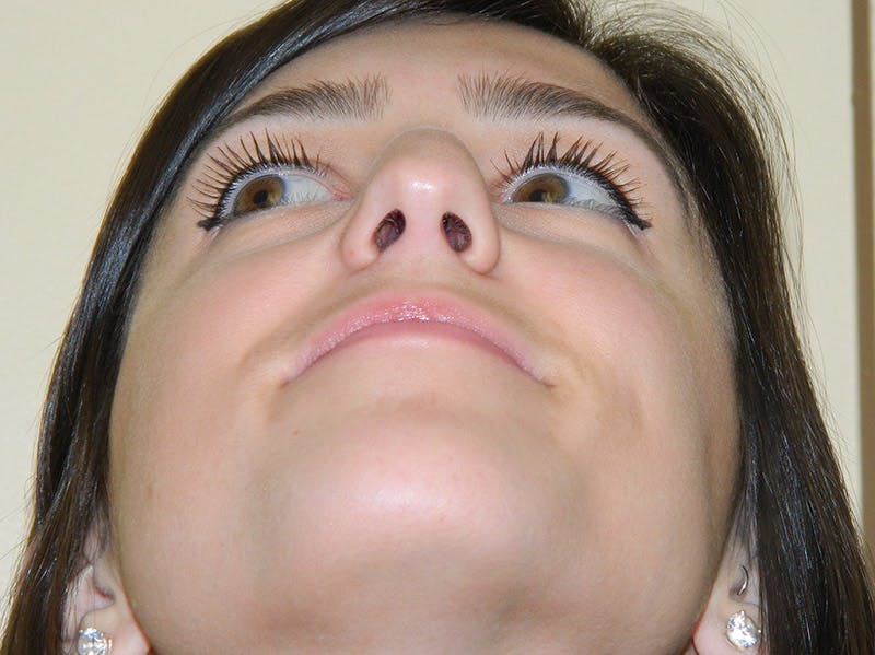 Rhinoplasty Before & After Gallery - Patient 133066651 - Image 9
