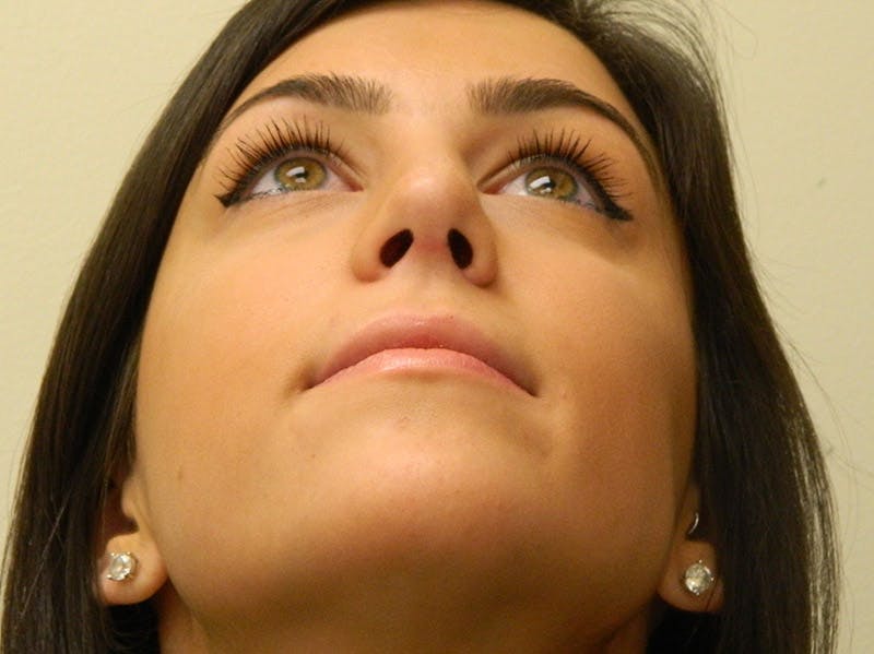 Rhinoplasty Before & After Gallery - Patient 133066651 - Image 10