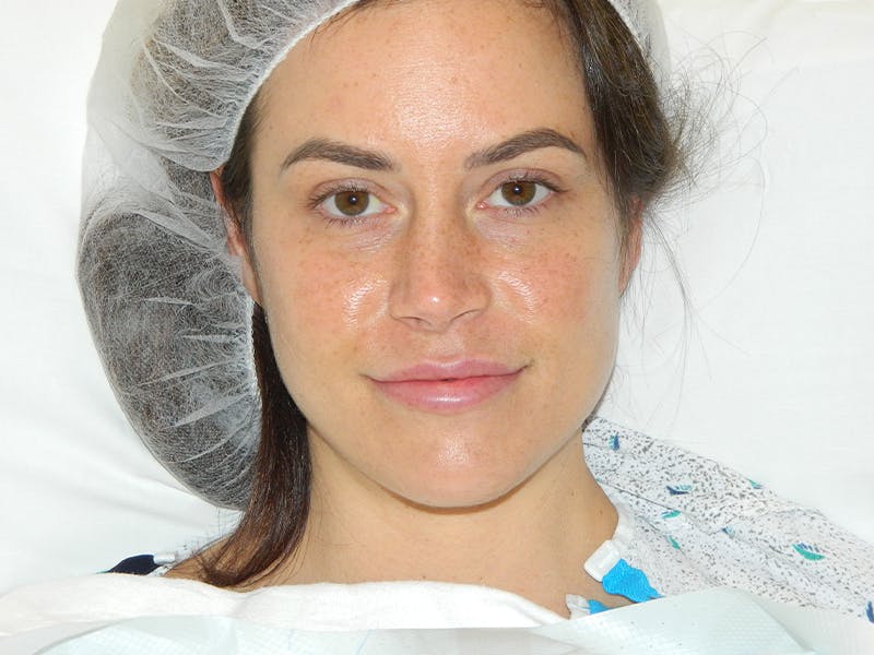 Rhinoplasty Before & After Gallery - Patient 133066653 - Image 1