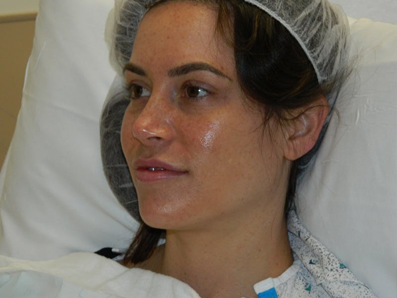 Rhinoplasty Before & After Gallery - Patient 133066653 - Image 3