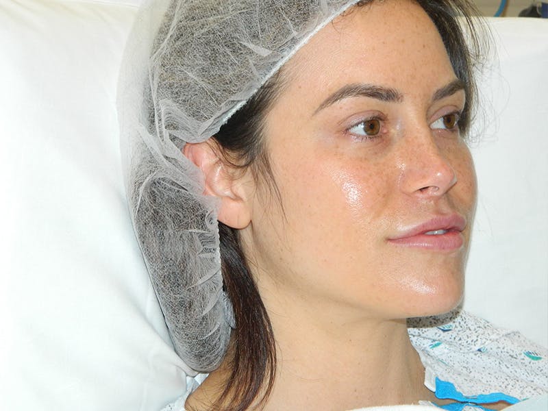 Rhinoplasty Before & After Gallery - Patient 133066653 - Image 5