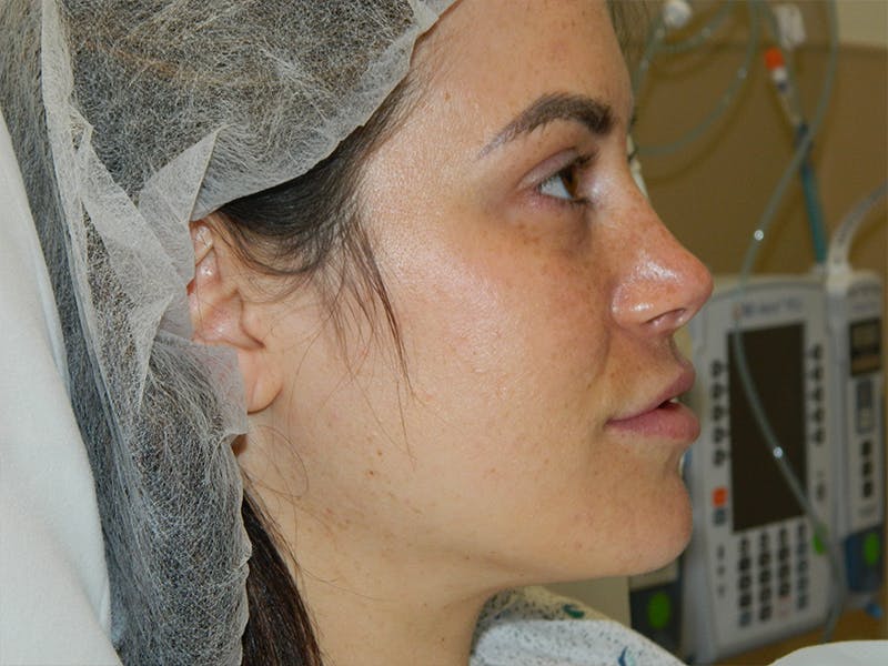 Rhinoplasty Before & After Gallery - Patient 133066653 - Image 7