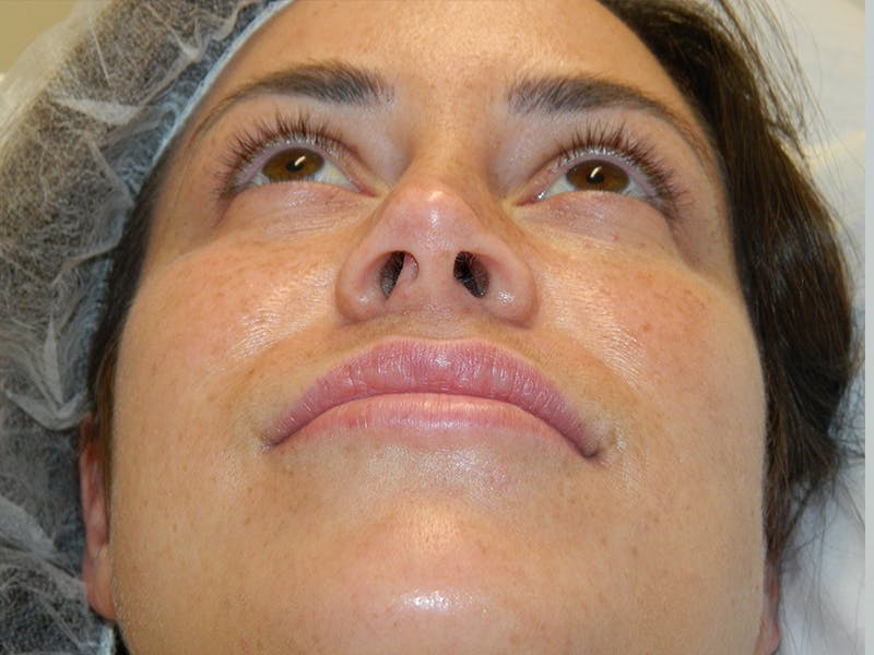 Rhinoplasty Before & After Gallery - Patient 133066653 - Image 9
