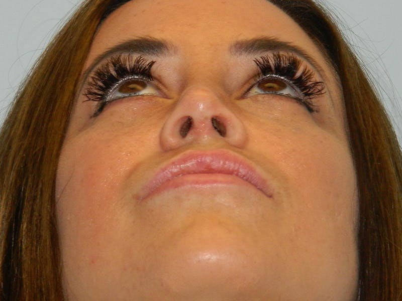 Rhinoplasty Before & After Gallery - Patient 133066653 - Image 10