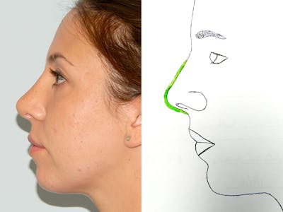 Rhinoplasty Before & After Gallery - Patient 133066656 - Image 2