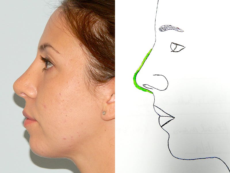 Rhinoplasty Before & After Gallery - Patient 133066656 - Image 2