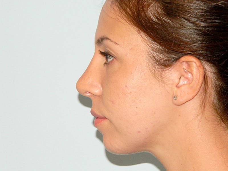 Rhinoplasty Before & After Gallery - Patient 133066656 - Image 4