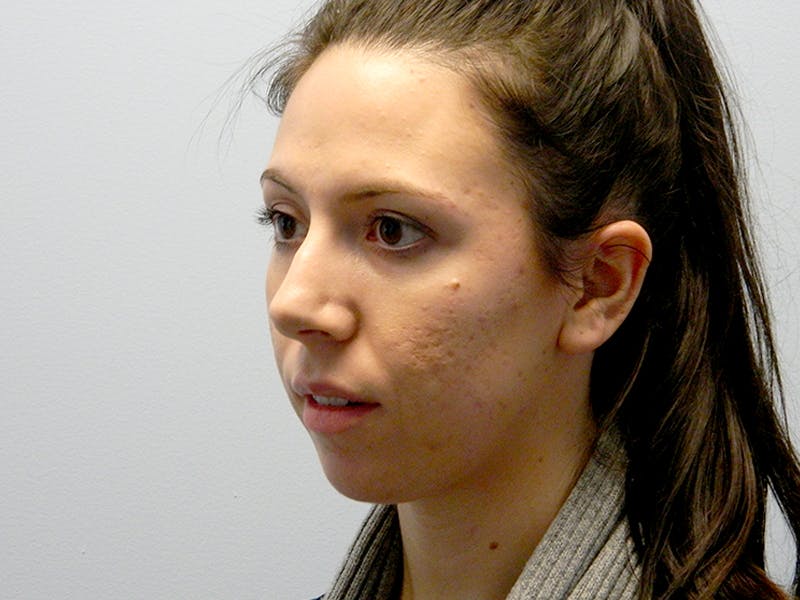 Rhinoplasty Before & After Gallery - Patient 133066656 - Image 5