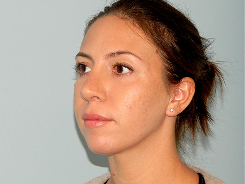 Rhinoplasty Before & After Gallery - Patient 133066656 - Image 6