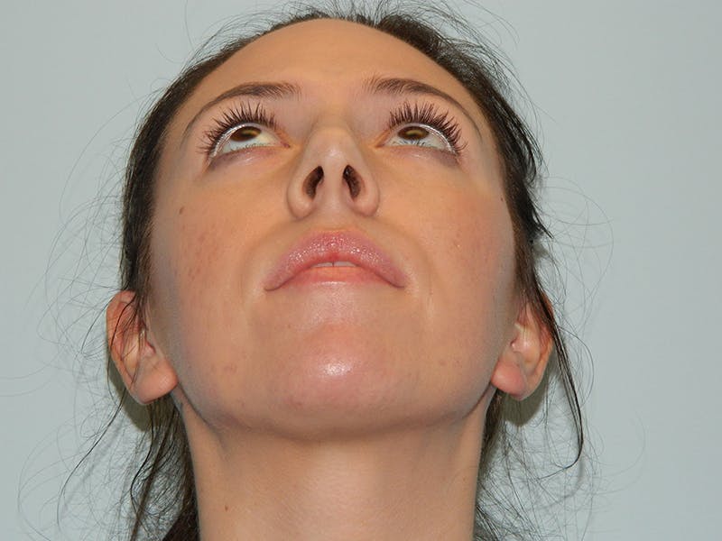 Rhinoplasty Before & After Gallery - Patient 133066656 - Image 7