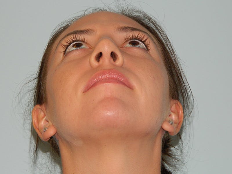 Rhinoplasty Before & After Gallery - Patient 133066656 - Image 8