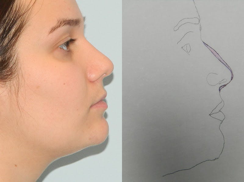 Rhinoplasty Before & After Gallery - Patient 133066658 - Image 2