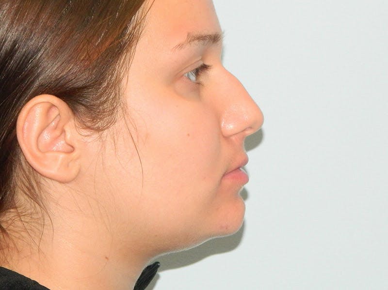 Rhinoplasty Before & After Gallery - Patient 133066658 - Image 3