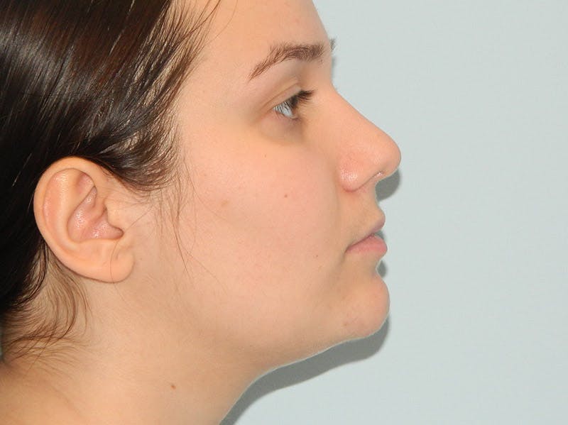 Rhinoplasty Before & After Gallery - Patient 133066658 - Image 4
