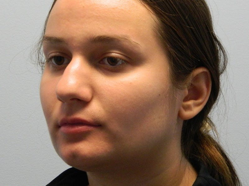Rhinoplasty Before & After Gallery - Patient 133066658 - Image 5
