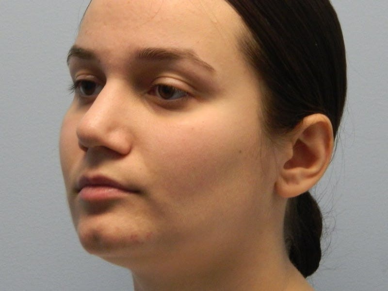 Rhinoplasty Before & After Gallery - Patient 133066658 - Image 6