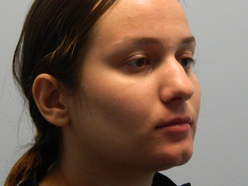 Rhinoplasty Before & After Gallery - Patient 133066658 - Image 7