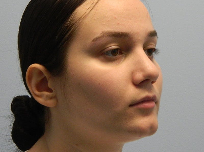 Rhinoplasty Before & After Gallery - Patient 133066658 - Image 8