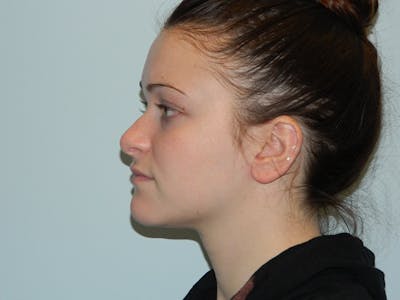 Rhinoplasty Before & After Gallery - Patient 133066661 - Image 1
