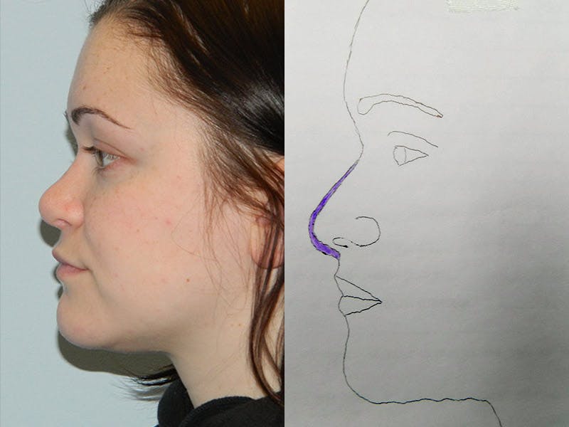 Rhinoplasty Before & After Gallery - Patient 133066661 - Image 2