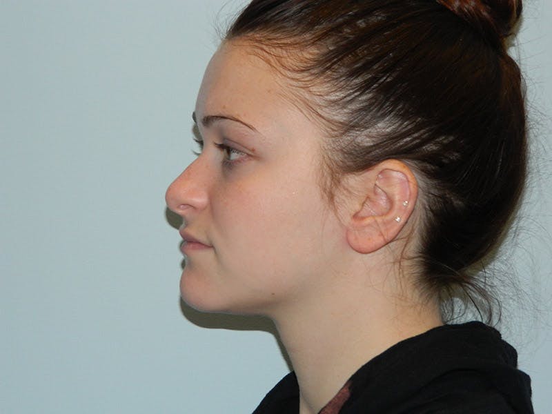 Rhinoplasty Before & After Gallery - Patient 133066661 - Image 3